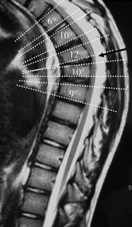 thoracic-kyphosis-MRI1